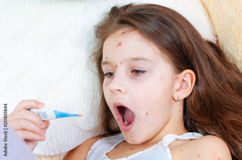 Closeup of cute sad little girl. Varicella virus or Chickenpox bubble rash on child