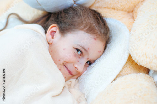 Closeup of cute funny little girl in the bed. Varicella virus or Chickenpox bubble rash on child