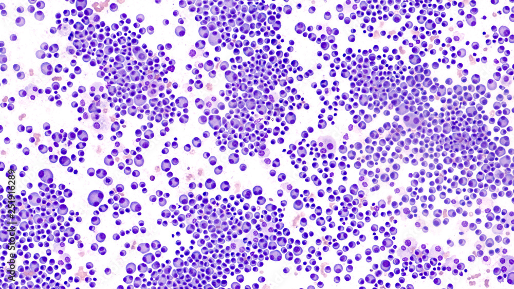 Foto Stock Multiple Myeloma Awareness: Bone marrow aspirate cytology of multiple  myeloma, a type of bone marrow cancer of malignant plasma cells, associated  with bone pain, bone fractures and anemia. | Adobe