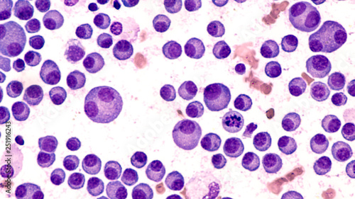 Multiple Myeloma Awareness: Bone marrow aspirate cytology of multiple myeloma, a type of bone marrow cancer of malignant plasma cells, associated with bone pain, bone  fractures and anemia.