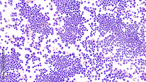 Multiple Myeloma Awareness: Bone marrow aspirate cytology of multiple myeloma, a type of bone marrow cancer of malignant plasma cells, associated with bone pain, bone  fractures and anemia.