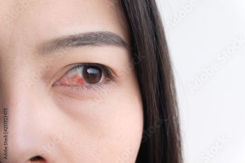 red eye. conjunctivitis or irritation of sensitive eyes.