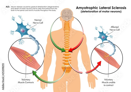 Amyotrophic Lateral Sclerosis photo