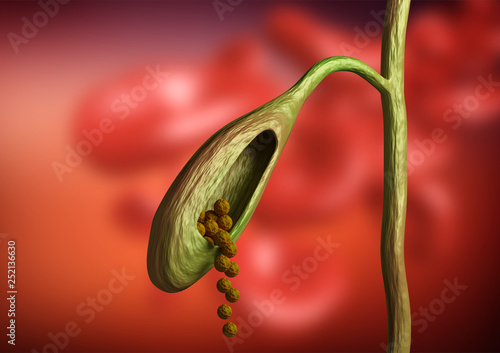 Gallbladder cutting showing gallstones obstructing bile duct on organic background photo