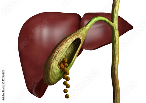 Gallstones in gallbladder and bile duct isolated white background photo