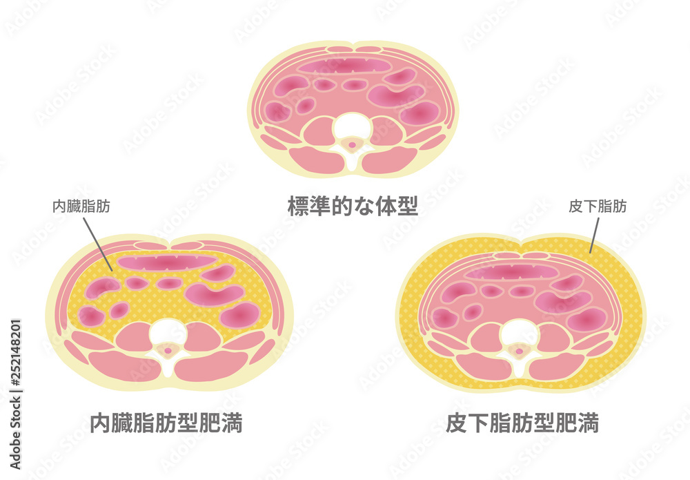 腹部断面図イラスト 肥満のタイプ 標準体型 内臓脂肪 皮下脂肪 Stock Vector Adobe Stock