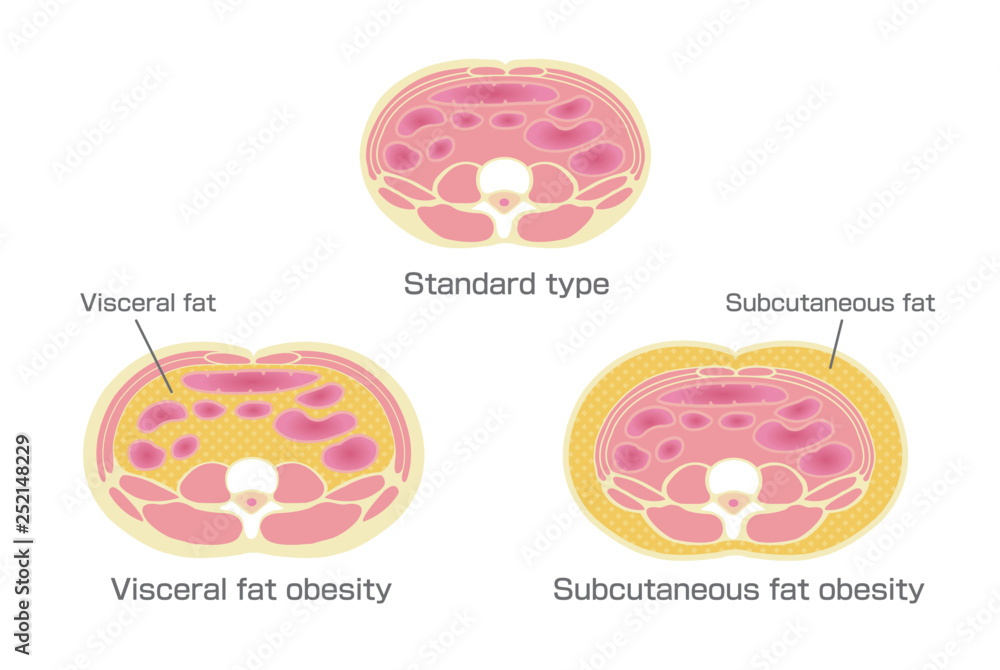 Type of obesity illustration. Abdominal sectional View. (visceral fat ...