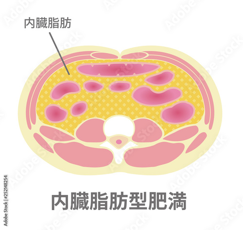 腹部断面図イラスト「肥満のタイプ」/ 内臓脂肪型肥満