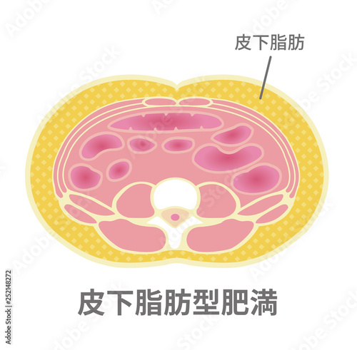 腹部断面図イラスト「肥満のタイプ」/ 皮下脂肪型肥満