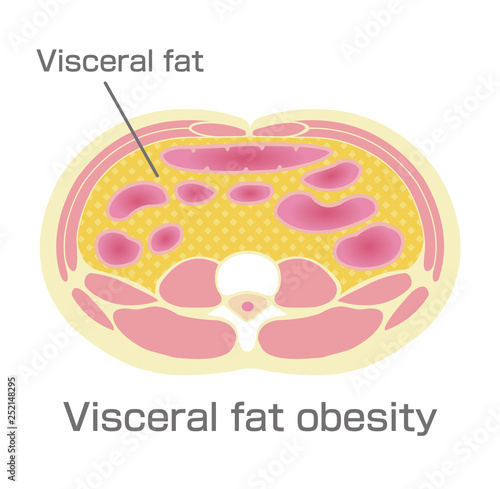 Type of obesity illustration . Abdominal sectional View (visceral fat ).