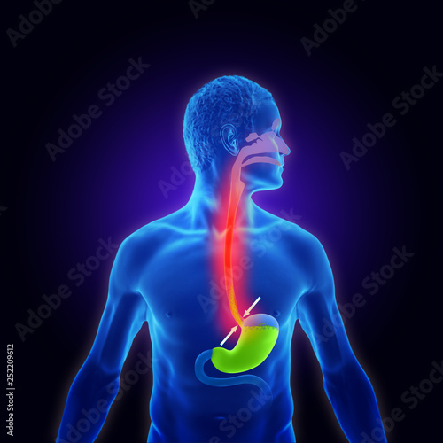 3d illustration of the stomach and esophagus and the symptoms of acid reflux disease or heartburn photo