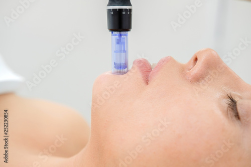 Cosmetologist making mesotherapy injection. Microneedle mesotherapy. Treatment woman at beautician. Hardware cosmetology. Mesotherapy, dermapen, treatment of face zone, face rejuvenation.  Close up photo