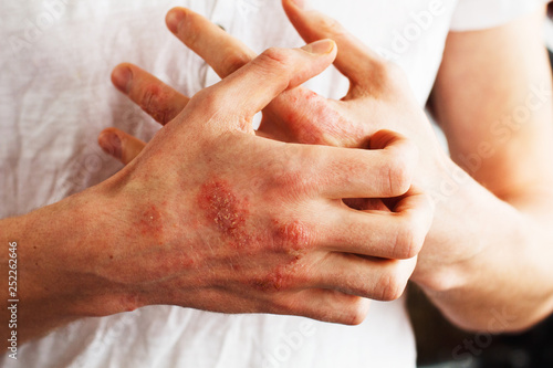 Man scratch oneself, dry flaky skin on hand with psoriasis vulgaris, eczema and other skin conditions like fungus, plaque, rash and patches. Autoimmune genetic disease.