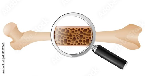 Animation drawing of human thigh bone with osteoporosis problem on white background. Two bones are normal and sore.   Video of the medical problem of osteoporosis disease