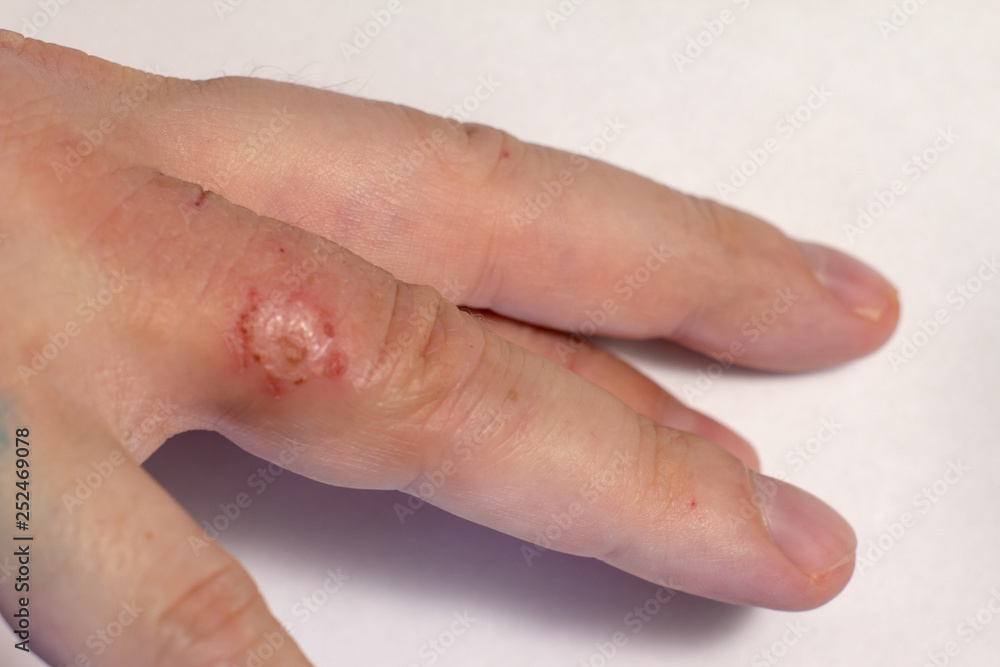 Hand dermatitis. Finger eczema Stock Photo Adobe Stock
