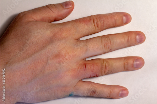 Hand dermatitis. Finger eczema photo
