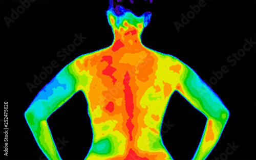 Thermographic photo of the back of the upper body of a woman with the photo showing different temperature in a range of colors from blue showing cold to red showing hot which can be joint inflammation