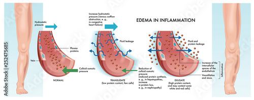 Main stages of edema inflammation illustrated in medical diagram. photo