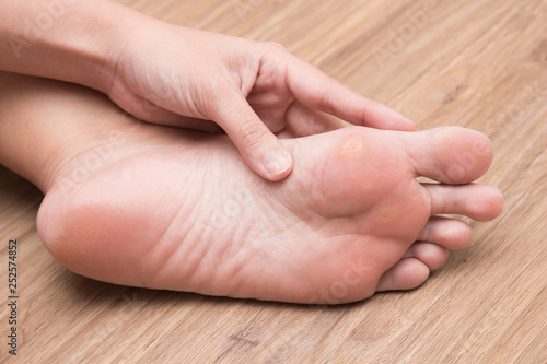 A woman suffering from corn on her foot sole © catinsyrup