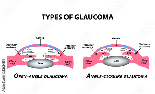 Types of glaucoma. Open-angle and angle-closure glaucoma. The anatomical structure of the eye. Infographics. Vector illustration on isolated background. photo