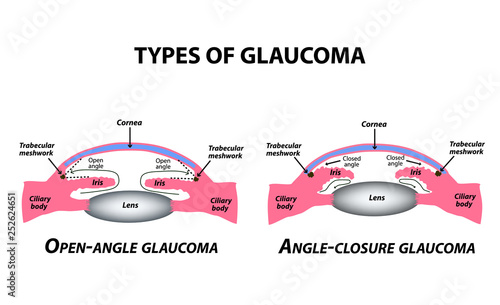 Types of glaucoma. Open-angle and angle-closure glaucoma. The anatomical structure of the eye. Infographics. Vector illustration on isolated background.