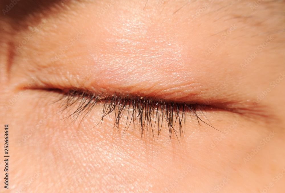 Obraz premium close up Blepharitis or Eyelid inflammation eyes healthy concept