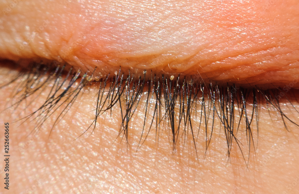 Fototapeta premium close up Blepharitis or Eyelid inflammation eyes healthy concept