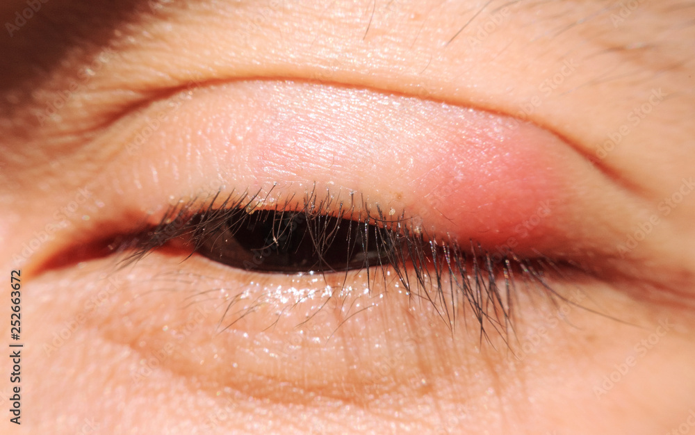 Obraz premium close up Blepharitis or Eyelid inflammation eyes healthy concept