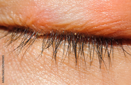 close up Blepharitis or Eyelid inflammation eyes healthy concept photo