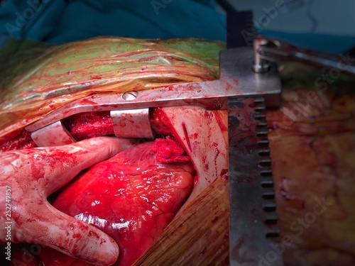 The heart was showed after emergency open surgery because patient was stabbed to heart then surgeon was massaging cardiac. A surgeon was stop bleeding by gauze suture. photo