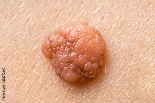 Macro photography of mole on a human skin