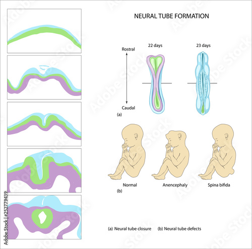 Nutrition and the Neural Tube. Neural tube formation.  anencephaly. Folic acid. biosynthesis of DNA. planning pregnancy. neural tube disease.  birth defect