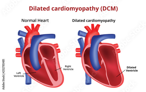 Dilated cardiomyopathy, Heart disease, Vector image photo