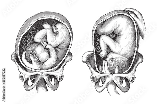 Child birth / vintage illustration from Die Frau als hausarztin 1911