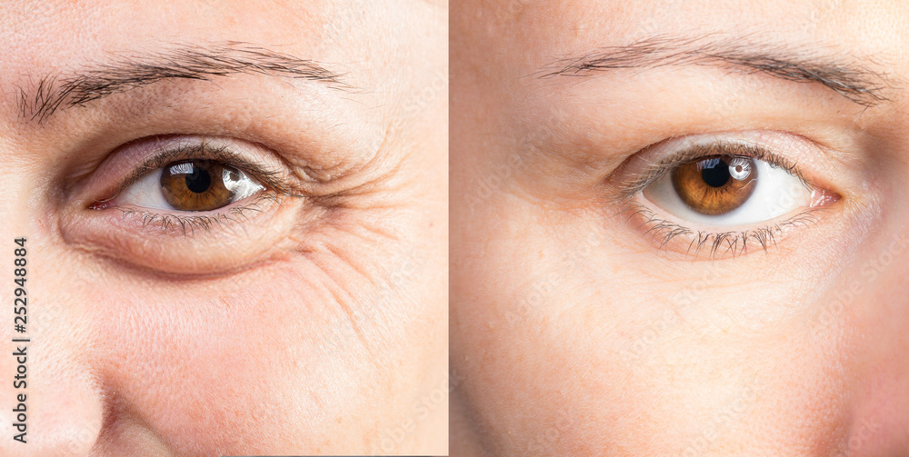 Wrinkled eye of beautiful lady before and after cosmetic treatment