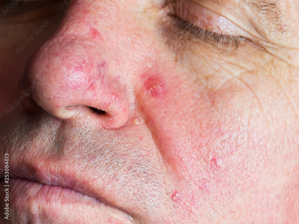 Demodecosis of the face. Reddened, inflamed skin. Pustular eruptions. Manifestation of small veins on the surface. Demodecosis of the face. Reddened, inflamed skin. Pustular eruptions. Manifestation of small veins on the surface.