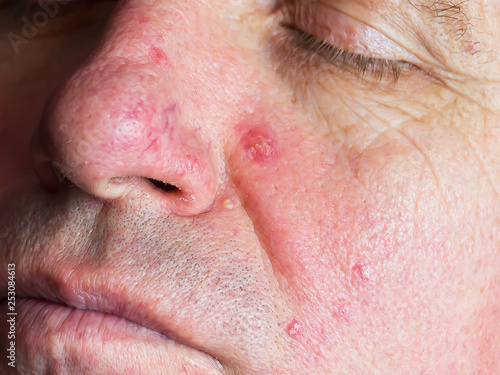 Demodecosis of the face. Reddened, inflamed skin. Pustular eruptions. Manifestation of small veins on the surface.