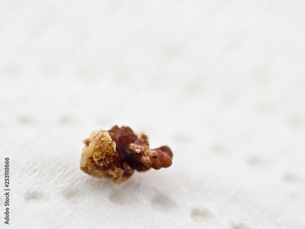 calcium oxalate stone kidney closeup. urolithiasis. copy space calcium oxalate stone kidney closeup. urolithiasis. copy space