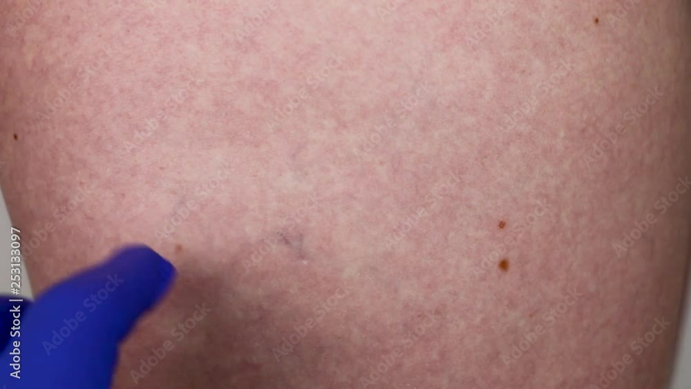 Capillary mesh on the leg of the girl. The doctor in blue silicone gloves examines the damage to the capillary Capillary mesh on the leg of the girl. The doctor in blue silicone gloves examines the damage to the capillary