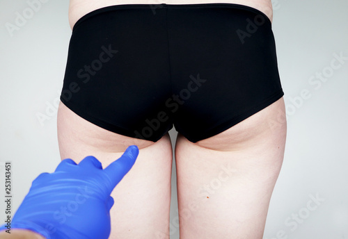 Fotografie Plastic surgery: femoroplasty, cruroplasty, buttocks endoprosthetics, gluteoplasty