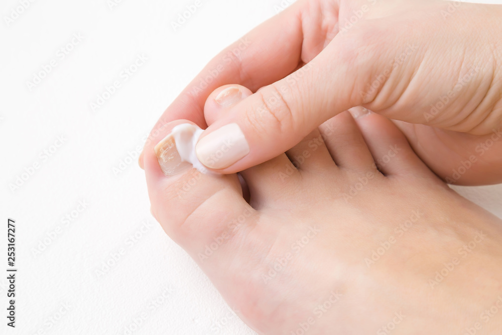 Young woman's hand using and applying moisturizing cream on foot nail. Dry, damaged toe nails. Woman's issues. Problem and solution. White background. Close up. Top view. Young woman's hand using and applying moisturizing cream on foot nail. Dry, damaged toe nails. Woman's issues. Problem and solution. White background. Close up. Top view.