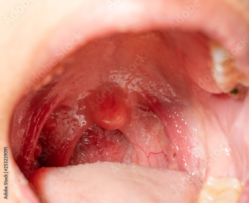 Sore throat with throat swollen. Closeup open mouth with posterior pharyngeal wall swelling and uvula and tonsil. Influenza follicles in the posterior pharyngeal wall. Upper respiratory tract.