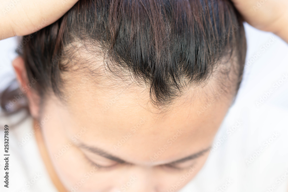 Woman serious hair loss problem for health care shampoo and beauty product concept, selective focus