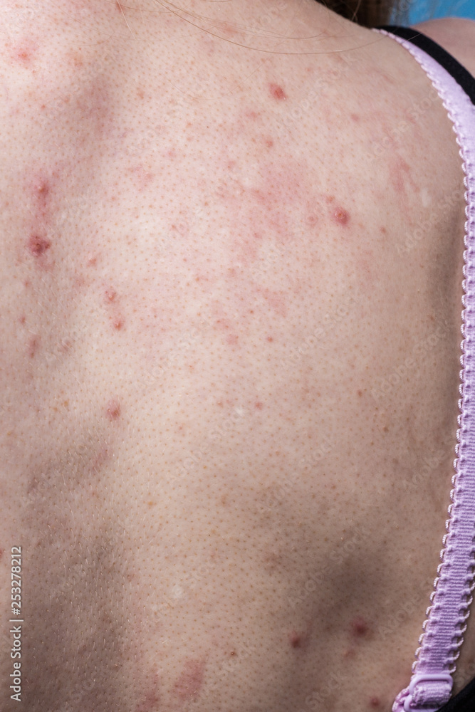 Fototapeta premium woman with skin problem acne on back