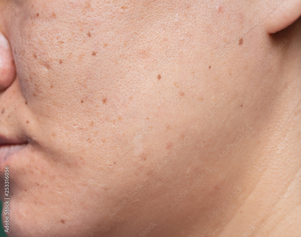 Woman 's problematic skin , acne scars ,oily skin and pore, dark spots and blackhead and whitehead on the face. Woman 's problematic skin , acne scars ,oily skin and pore, dark spots and blackhead and whitehead on the face.