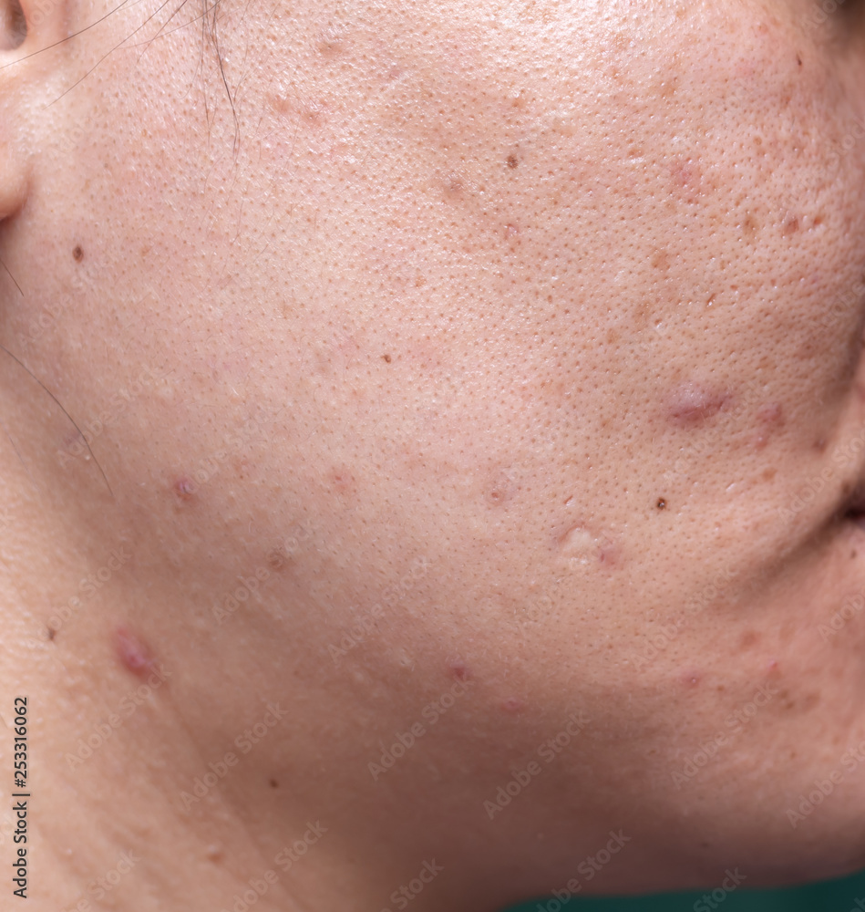 Woman 's problematic skin , acne scars ,oily skin and pore, dark spots and blackhead and whitehead on the face. Woman 's problematic skin , acne scars ,oily skin and pore, dark spots and blackhead and whitehead on the face.
