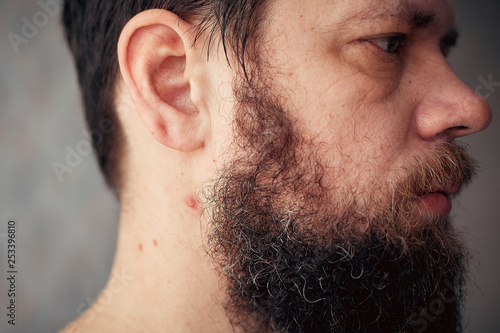 festering pimple on a man's neck,the bearded man has problems with skin