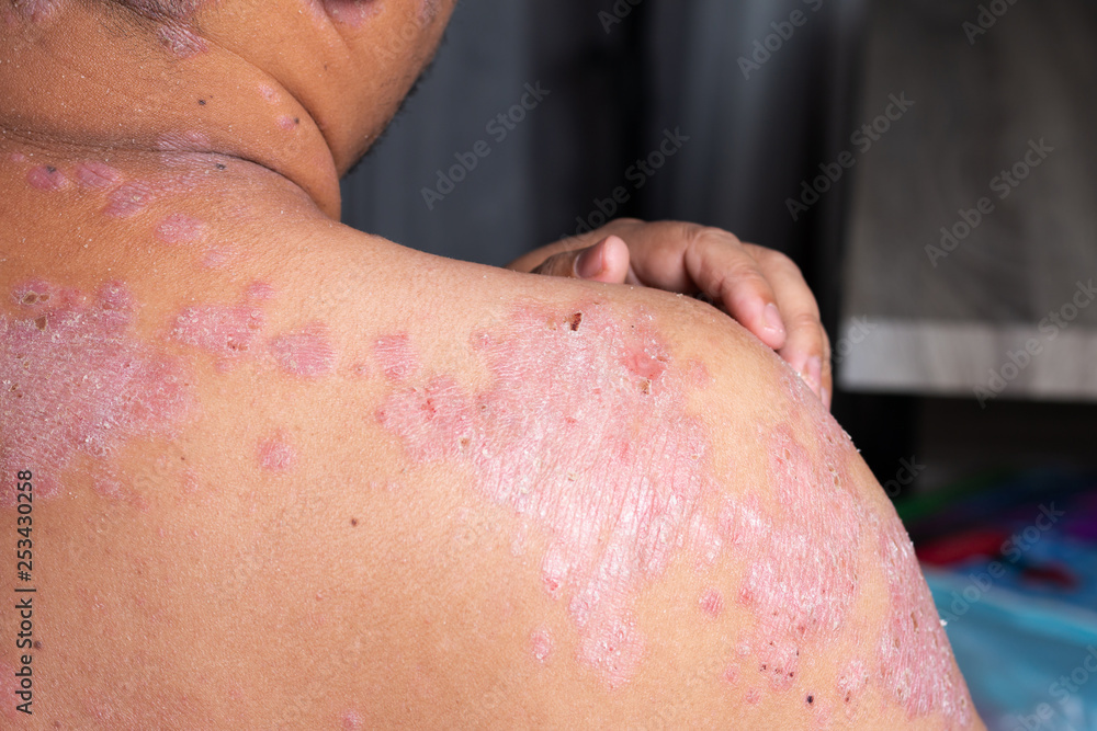 Fototapeta premium Men are using his hands to scratch the shoulder ulcers