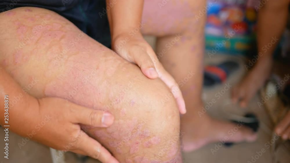 Psoriasis patients use herbal medicines to use their own legs with wounds. Diseases caused by abnormalities of the lymph and a skin disease. Psoriasis patients use herbal medicines to use their own legs with wounds. Diseases caused by abnormalities of the lymph and a skin disease.