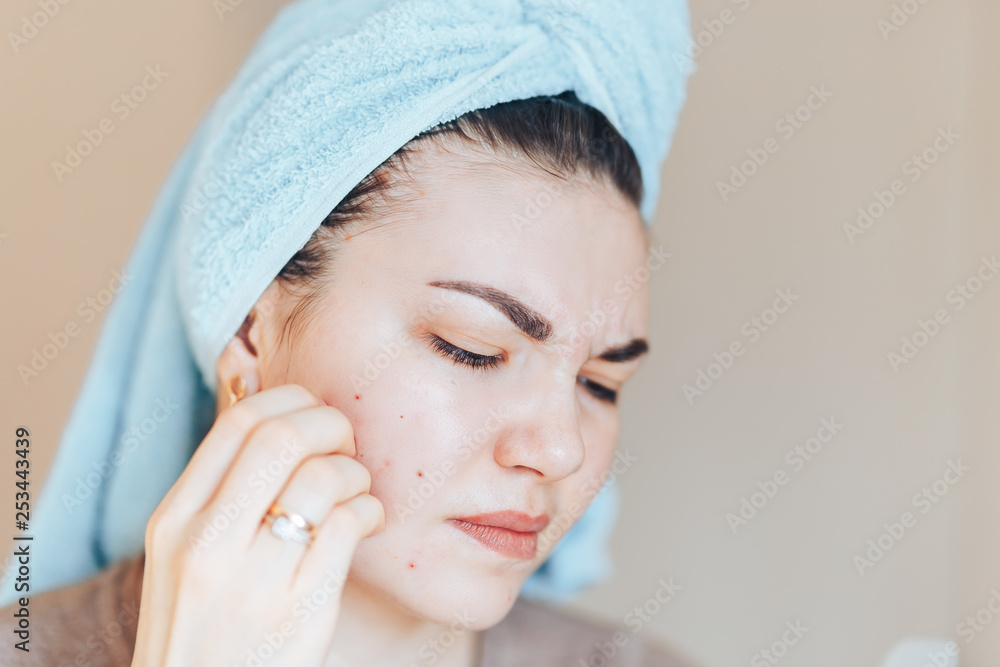 Pretty girl with towel on head squeezing pimple in towel on her head. Pretty girl with towel on head squeezing pimple in towel on her head.